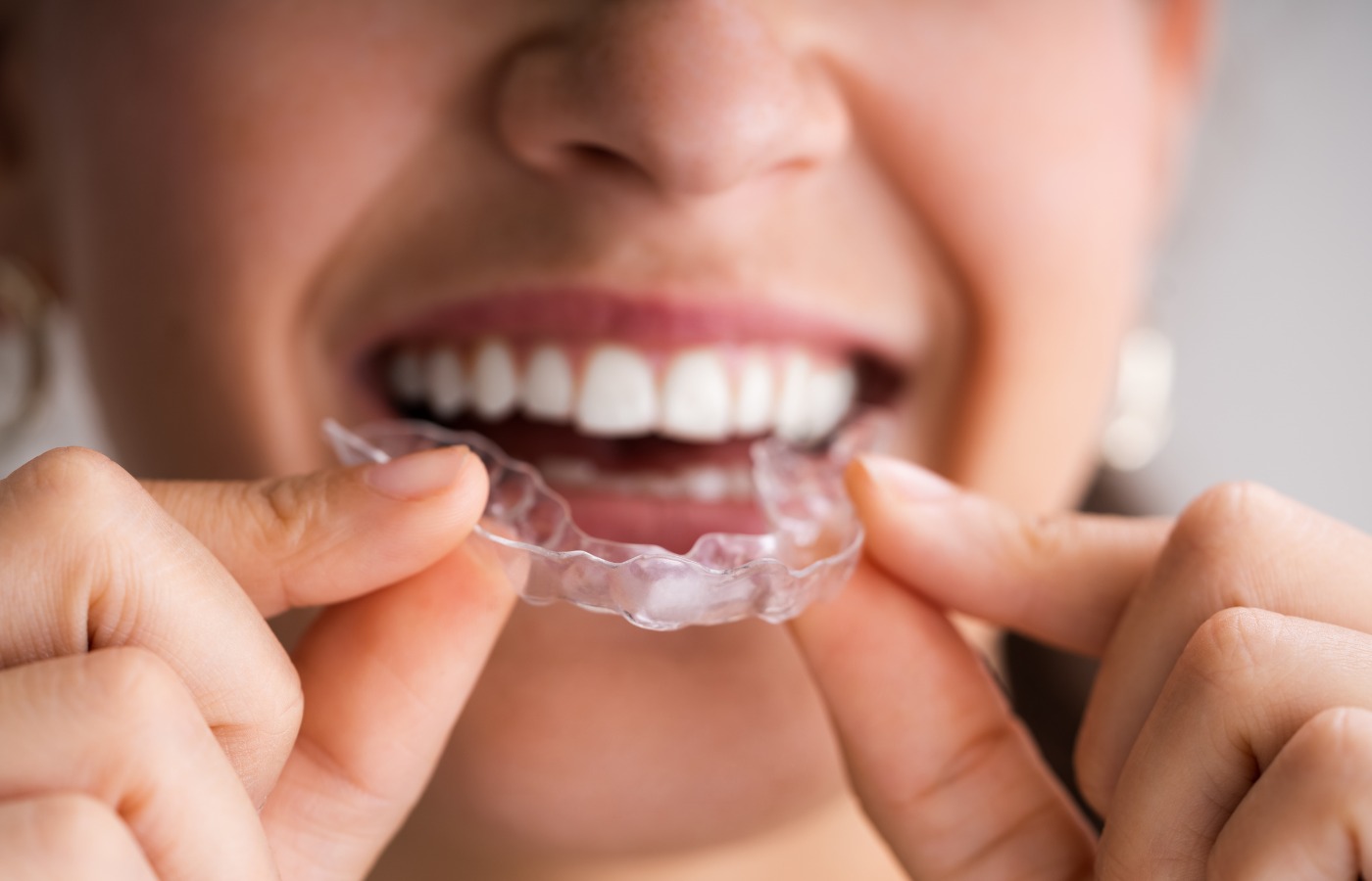 Things You Should About Dental Aligners